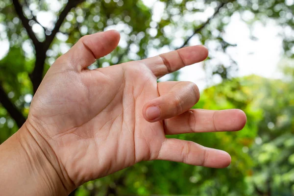 Acionador Finger lock no dedo médio da mão esquerda da mulher, Sofrendo de dor, Bokeh verde jardim fundo, conceito de cuidados de saúde — Fotografia de Stock