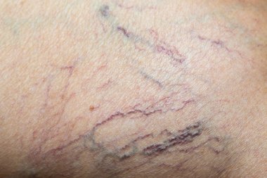 Yaşlı kadınlarda varisli damarlar, Makro şutu kapat, seçici odak, Asya vücut parçası, sağlık sigortası konsepti