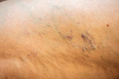 Yaşlı kadınlarda varisli damarlar, Makro şutu kapat, seçici odak, Asya vücut parçası, sağlık sigortası konsepti