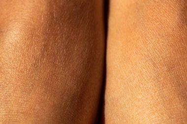 Bacakta kadının kuru cildi, Yakın çekim & Makro çekim, Asya Vücut cilt parçası, Sağlık kavramı, Soyut arka plan