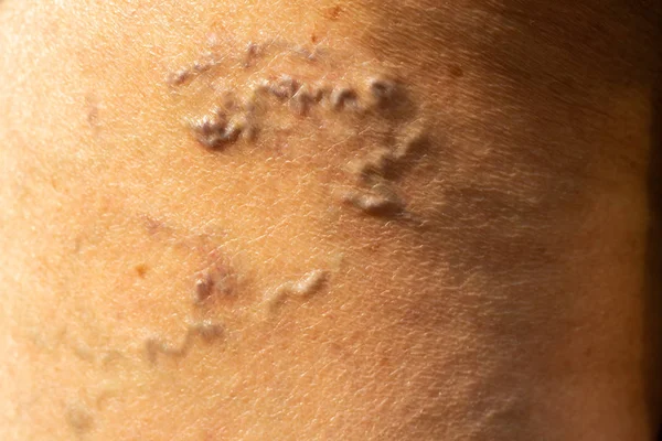 Veias varicosas em uma perna em mulheres Sênior, Close up & Macro tiro, Foco seletivo, Parte da pele do corpo asiático, Conceito de cuidados de saúde — Fotografia de Stock