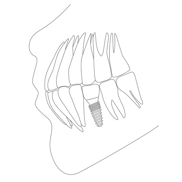 Reemplazo Dental Concepto Implante Dental Esquema Vectorial Ilustración — Archivo Imágenes Vectoriales