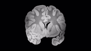 Koronal görüntüdeki sağlıklı yarımküreye kıyasla Alzheimer beyni, kortikal körelmeyi, ventriküler genişlemeyi ve nörodejenerasyon değişikliklerini vurguluyor.