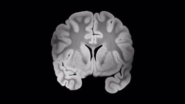 Alzheimer hastalığı, koronal beyin dilimlerinde görülebilir kortikal atrofi ventriküler genişleme ve ilerleyen beyin dokusu kaybı ile siyah arka planda ilerler.