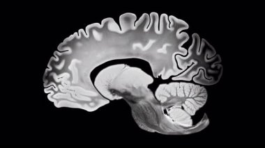 Sagittal beyin görselleştirmesi siyah arka planda Alzheimer bağlantılı kortikal körelme ve ventriküler büyümeyi gösteriyor, nörodejenerasyon ve yapısal beyin değişikliklerini vurguluyor..