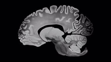 Sagittal beyin görselleştirmesi, alzheimer ilerlemesini kortikal incelme ve ventriküler genişlemeyi şeffaf bir arka planda gösteriyor, nörodejenerasyon ve anatomik değişimi vurguluyor.