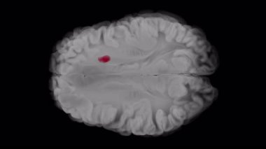 Sol frontal lobda glioblastoma eksensel animasyonu gelişiyor. Tümör doku sıkışması ve ilerleyen orta hat kayması ile büyür. Şeffaf arkaplan.