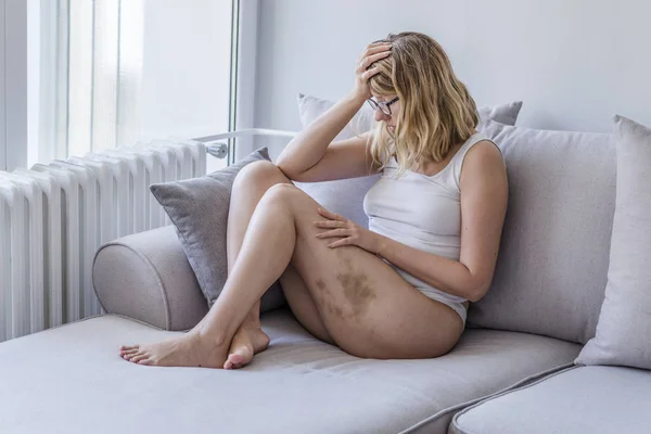 Stop Kwetsen Vrouw Verminkte Vrouwen Haar Gekneusd Gezicht Met Schaamte — Stockfoto