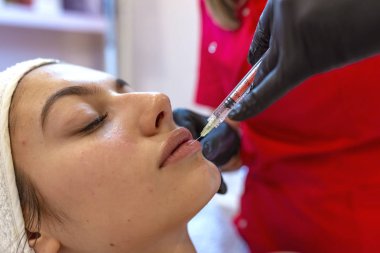 Dudak dolgu enjeksiyon prosedürü yakın çekim  