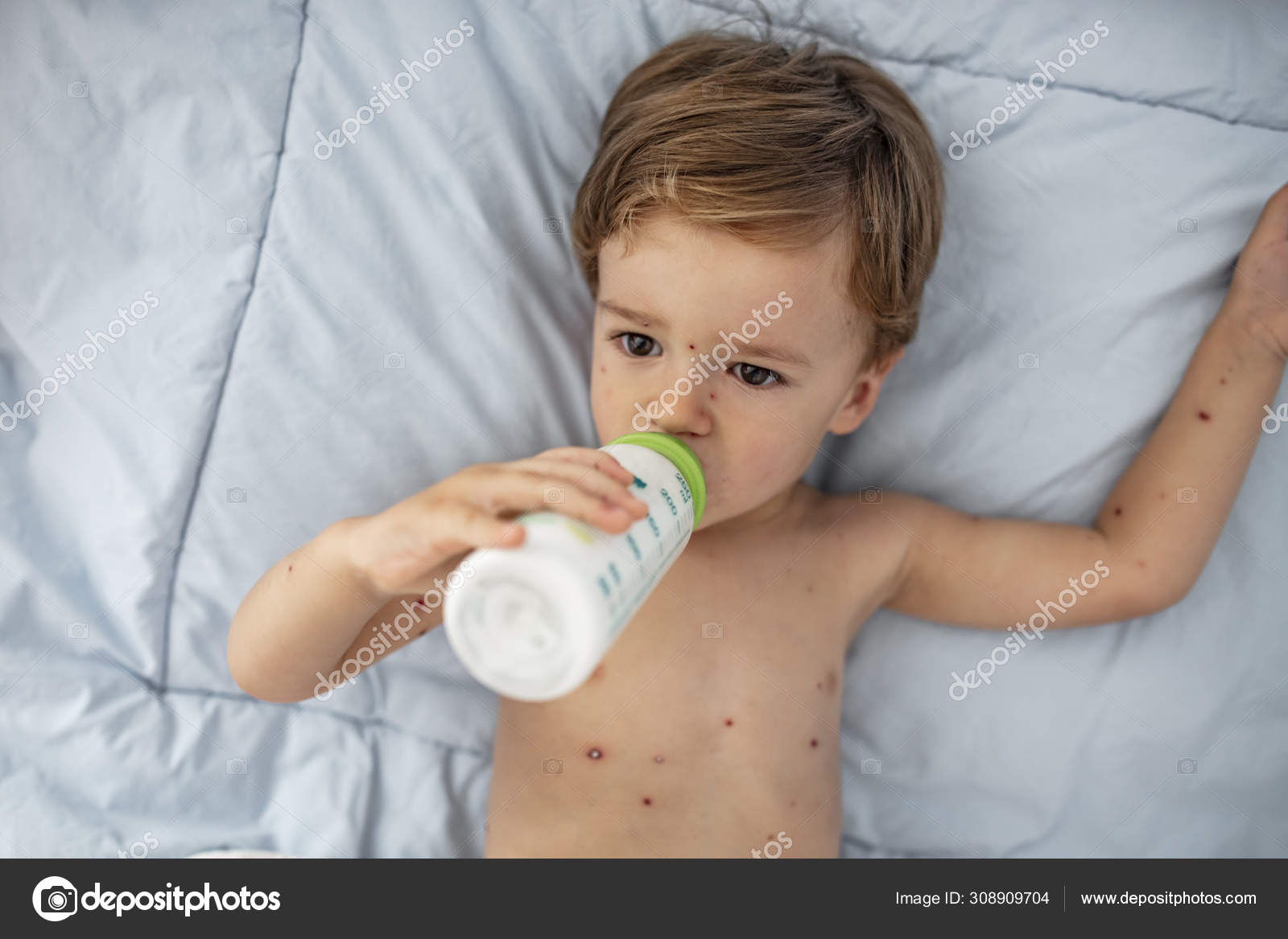 Baby Boy Chicken Pox Drinking Milk Bottle Baby Drinking Milk