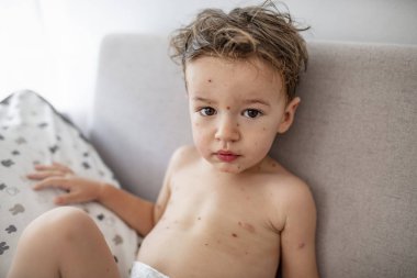 Suçiçeği olan genç bir çocuk. Suçiçeği olan hasta çocuk. Varisella virüsü veya suçiçeği kabarcık döküntü çocuk. Çiçek li küçük çocuğun portresi. 