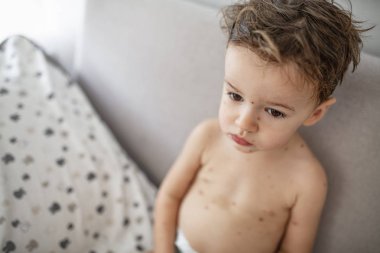 Çiçek hastalığı olan küçük çocuğun portresi. Suçiçeği kabarcıkları da 2 yaşındaki erkek baş ve saç üzerinde varisella olarak bilinen. Son derece bulaşıcı cilt hastalığı kavramı. Benekli tenli çocuk. Tıbbi konsept 