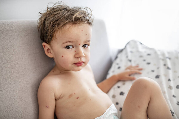 Young toddler with chickenpox. Sick child with chickenpox. Varicella virus or Chickenpox bubble rash on child. Portrait of little boy with pox. 