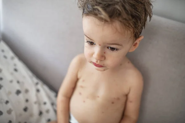 Child with spotted skin. Medical concept. Baby boy with mid-stage chicken pox. Young boy with varicella zoster virus. Portrait of little boy with pox.