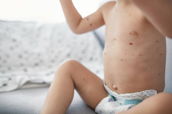 Young toddler with chickenpox. Varicella virus or Chickenpox bubble rash on child. Little boy with varicella zoster virus. Child with spotted skin. Medical concept 