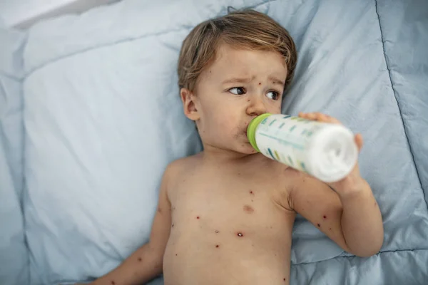 Παιδί Πιτσιλωτό Δέρμα Που Πίνει Γάλα Ιατρικό Σκεπτικό Αγοράκι Ανεμοβλογιά — Φωτογραφία Αρχείου