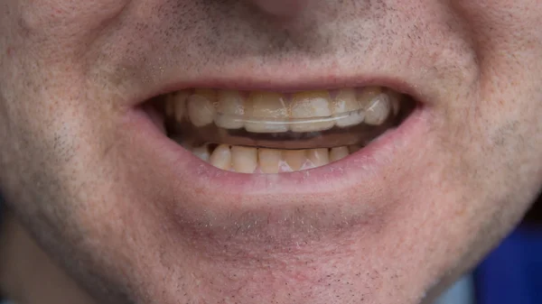 Homem Usando Dente Protegendo Protetor Bucal Closeup — Fotografia de Stock