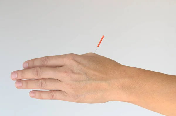Close up of extended hand with acupuncture needle attached to the knuckle against a white background