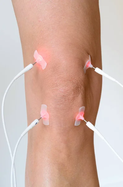 Patient having electrode therapy, or electrical muscle stimulation, on a knee joint using electrical stimulation to treat muscle pain and prevent atrophy after injury