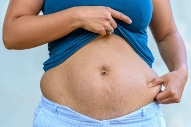 Woman displaying stretch marks on her abdomen after pregnancy caused by tearing of the dermis layer of the skin and showing as red discolorations clipart