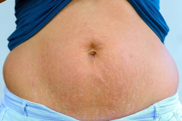 妊娠後の彼女の腹部のストレッチ マークを表示する女性は皮膚の真皮層の断裂によって引き起こされ 彼女の腹の赤い変色としてクローズ アップ — ストック写真