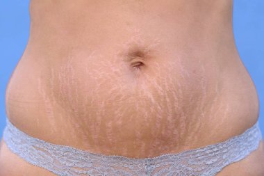 Streç işaretleri karnının üzerinde gebelik sonrası görüntüleme kadın cilt DermIS tabakası yırtılma tarafından neden olduğu ve kırmızı lekeler gösterilen karnı yakın çekim