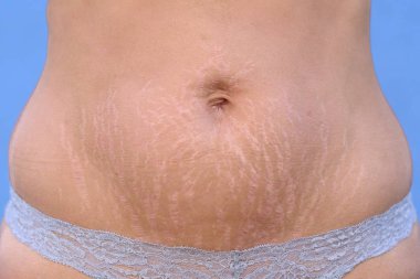Woman displaying stretch marks on her abdomen after pregnancy caused by tearing of the dermis layer of the skin and showing as red discolorations, close up of her belly clipart