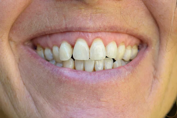 Sonriente boca y dientes de una mujer mayor — Foto de Stock