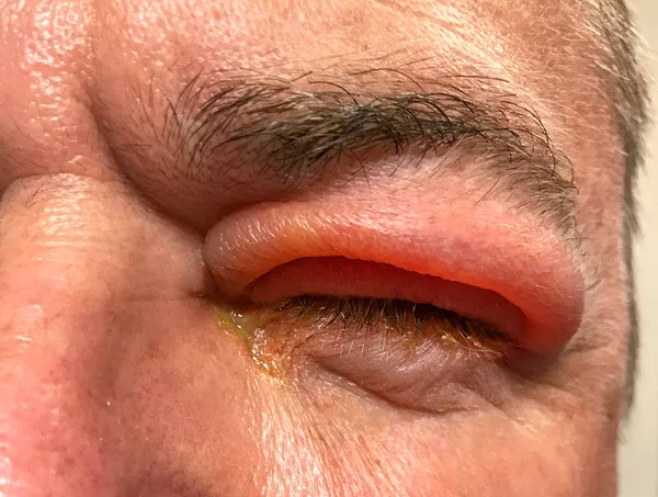 Detail of badly swollen upper eyelid of a man — Stock Photo, Image