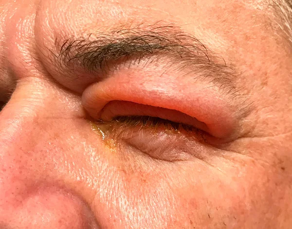 Detail of badly swollen upper eyelid of a man — Stock Photo, Image