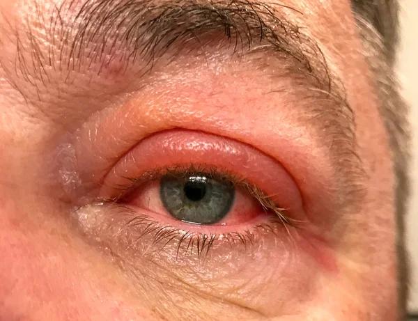 Extreme close up on a man with a red inflamed eye — Stock Photo, Image