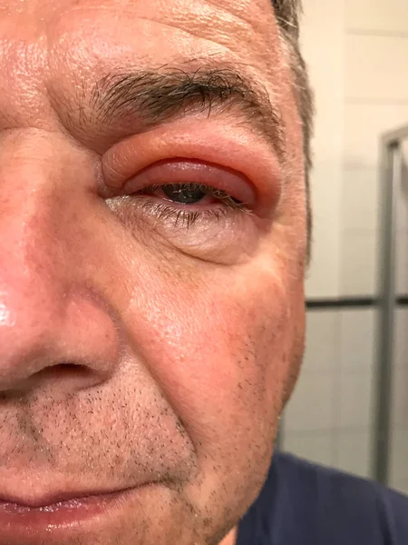 Close up on a man with a swollen eye — Stock Photo, Image