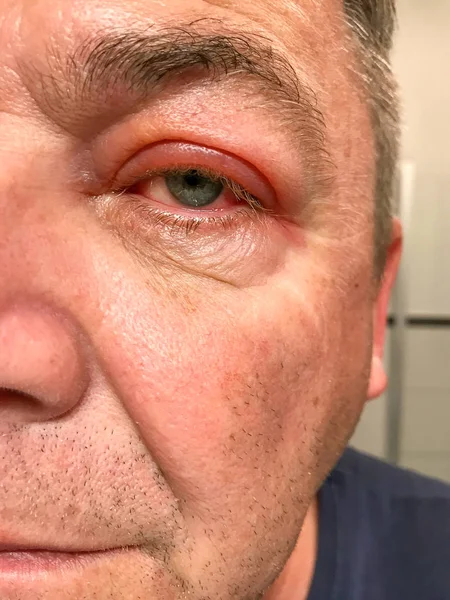 Close up on a man with a red inflamed eye