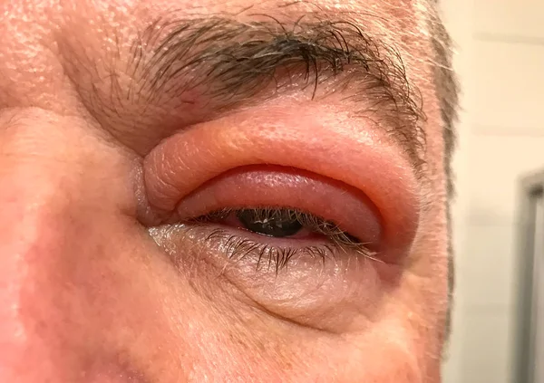 Detail of badly swollen upper eyelid of a man — Stock Photo, Image