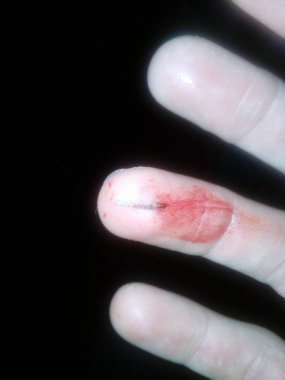 Kan ile parmak çok büyük kıymık