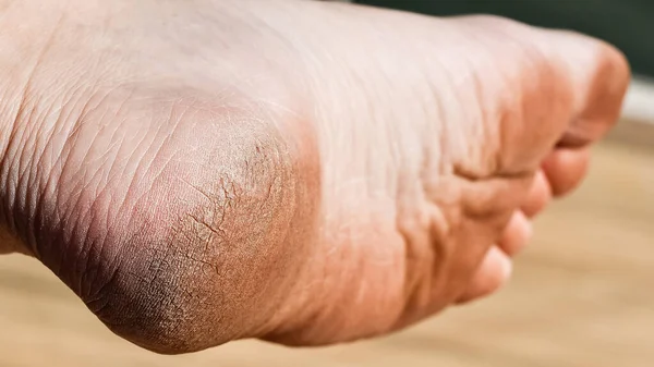 Man Cracked Heel Dirt Feet Cracked Feet Due Walking Barefoot — Stock Photo, Image