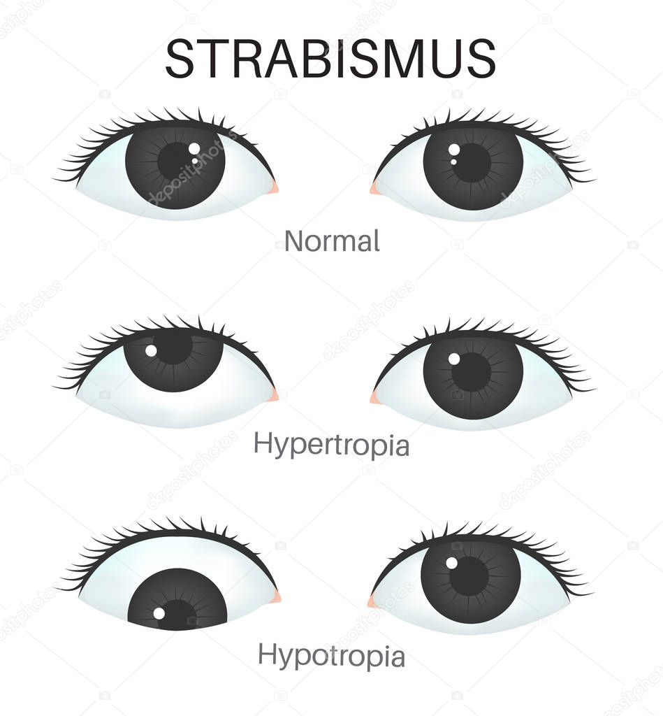 types of strabismus human.
