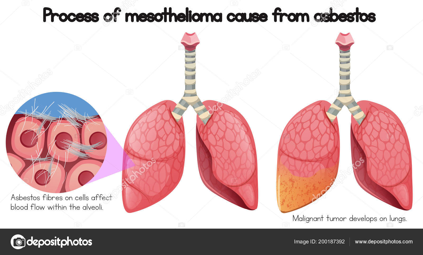 mesothelioma chemotherapy alimta