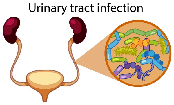 Ilustração Infecção Trato Urinário Humano — Vetor de Stock