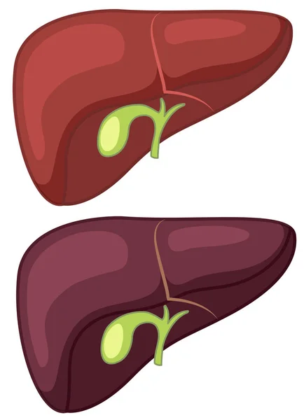 Ilustrasi Liver Sehat Dan Cirrhosis - Stok Vektor