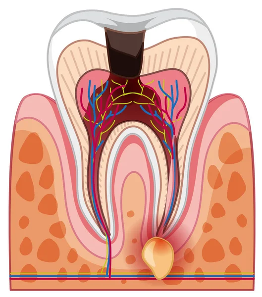 ヒトの虫歯とキャビティの図 — ストックベクタ