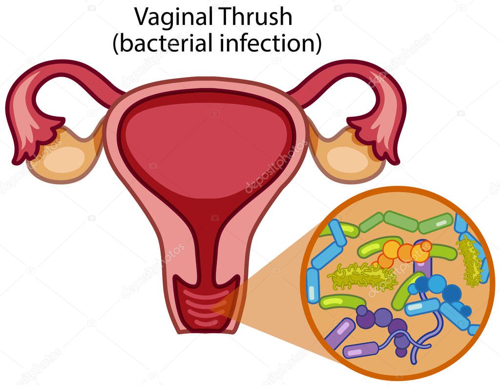 Vaginal Thrush on White Background illustration