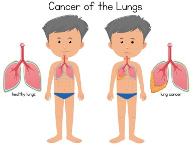 Kanser akciğer illüstrasyon