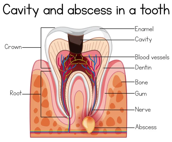 Hålrum Och Abscess Tand Illustration — Stock vektor