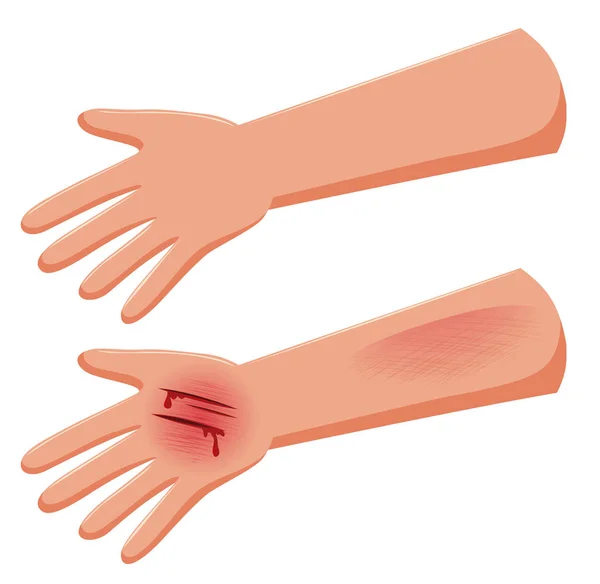 Uppsättning Injure Hand Illustration — Stock vektor