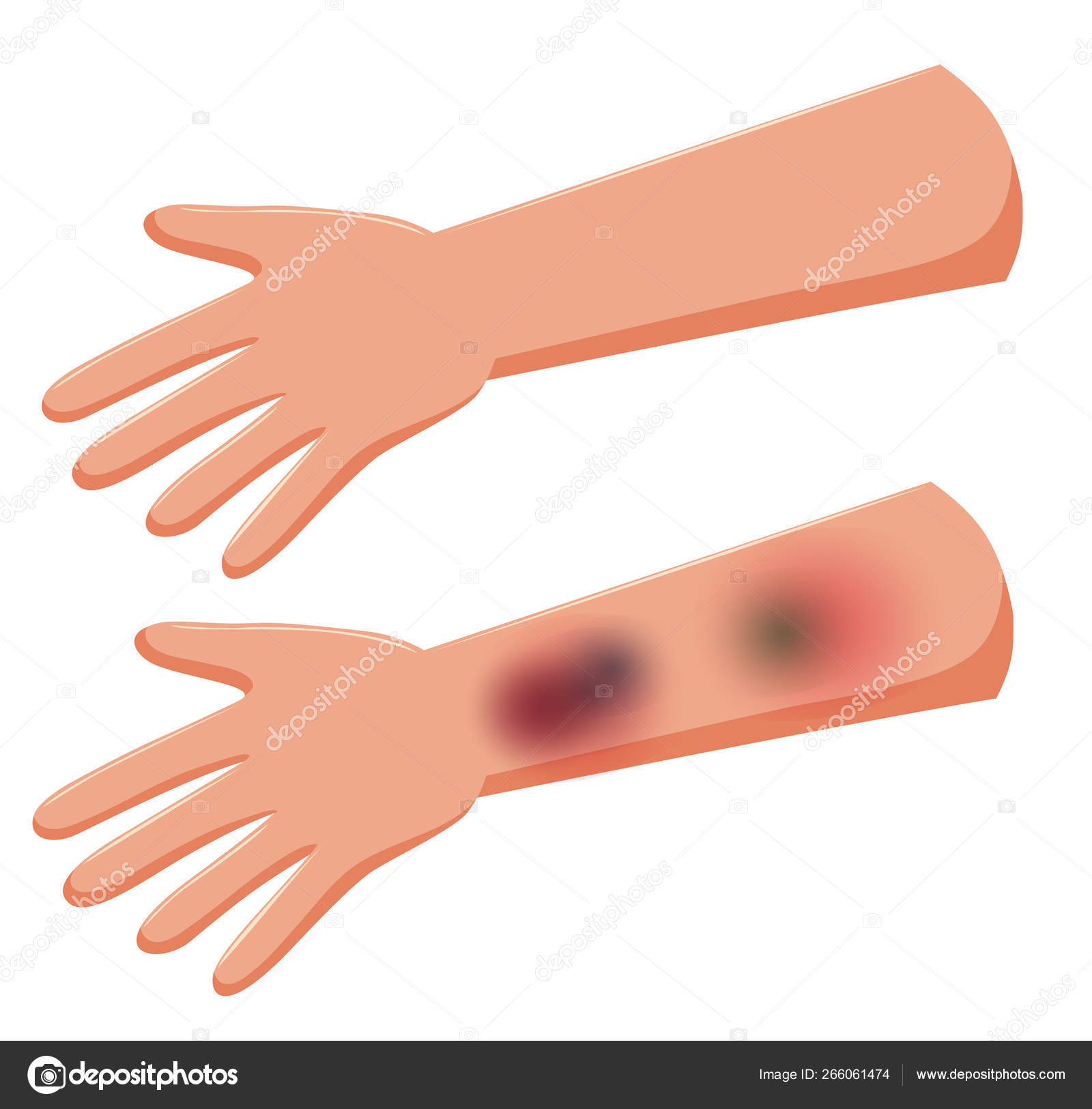 Set of bruising on hands Stock Vector Image by ©brgfx 266061474