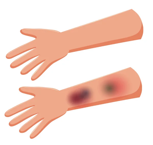 Conjunto de hematomas nas mãos —  Vetores de Stock