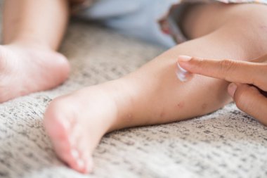 Bir kızın bacakları kırmızı nokta, blister ile krem uygulayarak anne. Tıp ve sağlık kavramı.