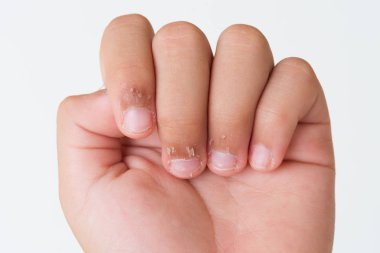 Çocuğun parmakları kuru cilt, Egzama Dermatit ile kapatın. Tıp ve sağlık kavramı.