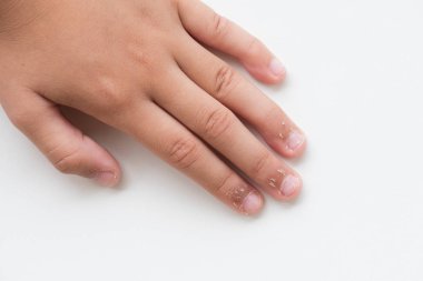 Çocuğun parmakları kuru cilt, Egzama Dermatit ile kapatın. Tıp ve sağlık kavramı.